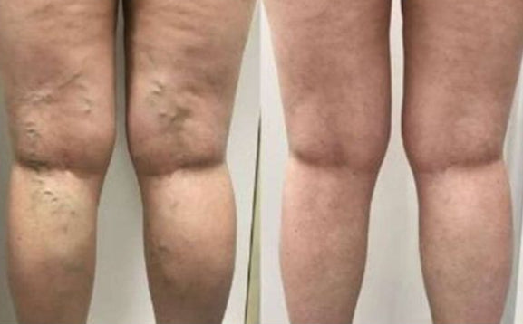 ParchSprayVital™ | Spray para alivio de varices + 12 parches (GRATIS) –  Noxa Store