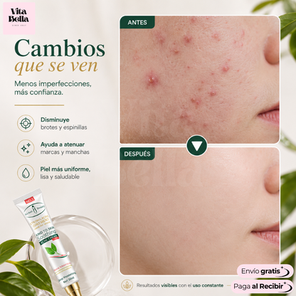 Acnegel™ | Gel para eliminar acné