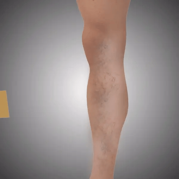 ParchSprayVital™ | Spray para alivio de varices + 12 parches (GRATIS) –  Noxa Store